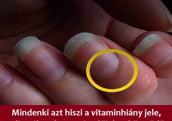 Mindenki azt hiszi a vitaminhiány jele, pedig súlyos betegség előjele lehet a körmödön lévő folt 01