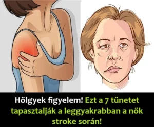 Holgyek-leggyakrabban-a-nok-stroke-soran