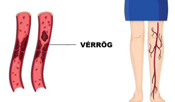 A vérrög 10 korai figyelmeztető jele, amit sohasem szabad figyelmen kívül hagyni 521516951_1176928444473561_3903835453109040315_n